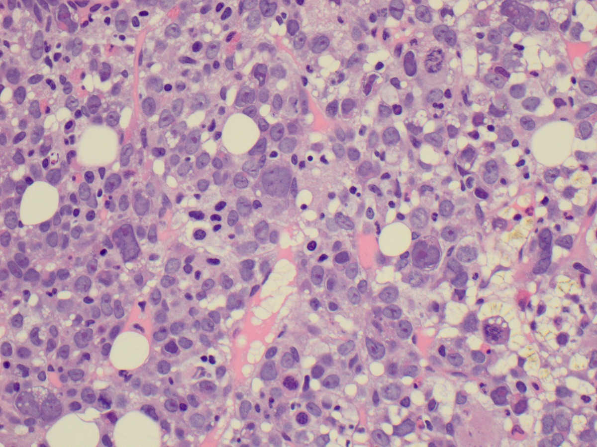 Bone marrow biopsy 40x